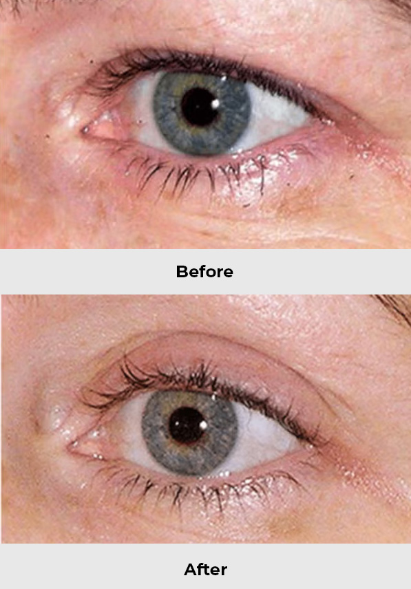 Radiofrequency Eye Lift  