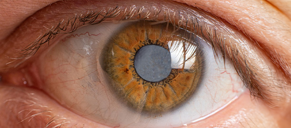 Cataract Exam